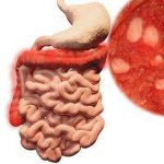 What is inflammatory bowel disease?