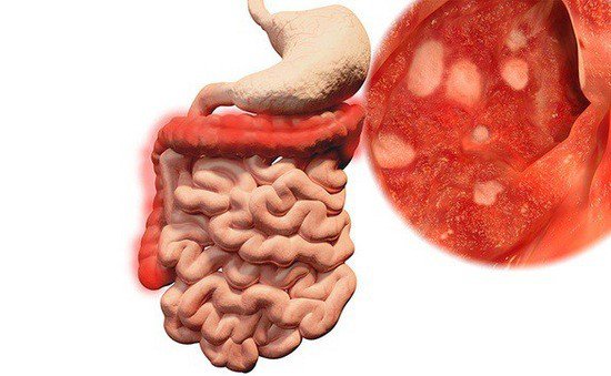 What is inflammatory bowel disease?