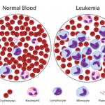 What is leukemia?