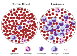 What is leukemia?