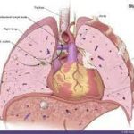 What is lung cancer?