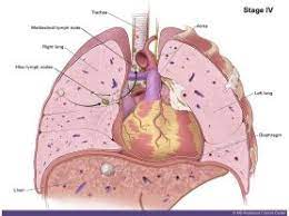 What is lung cancer?