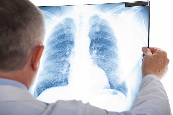 What is pulmonary tuberculosis?