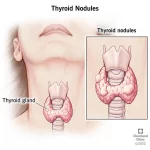 What is thyroid disease?