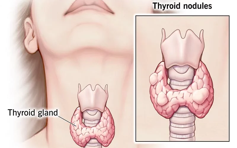 What is thyroid disease?